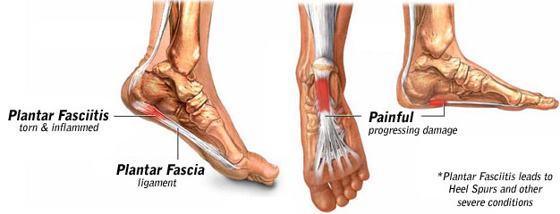image showing plantar fasciitis 