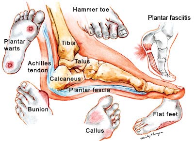 image showing various common foot problems 
