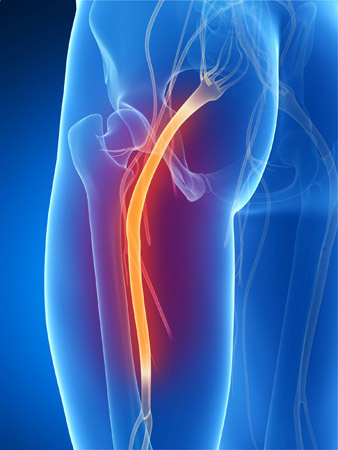 sciatica nerve pain relief